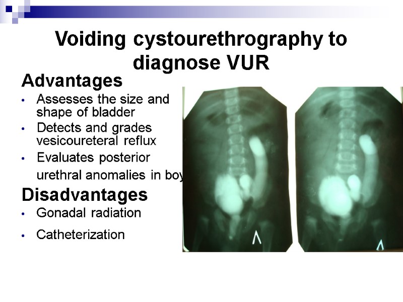 Voiding cystourethrography to diagnose VUR Advantages Assesses the size and shape of bladder 